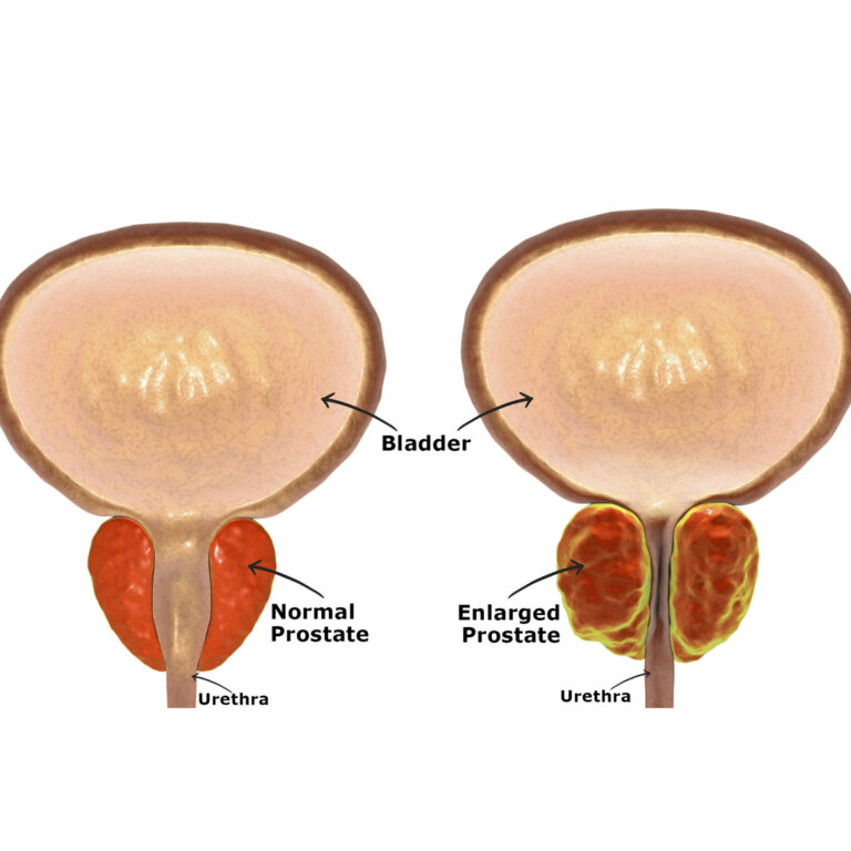 Benign prostatic hyperplasia